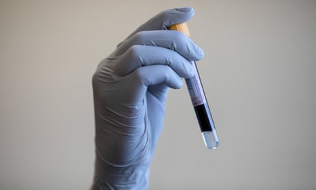 Blood test spots multiple cancers without clear symptoms, study finds