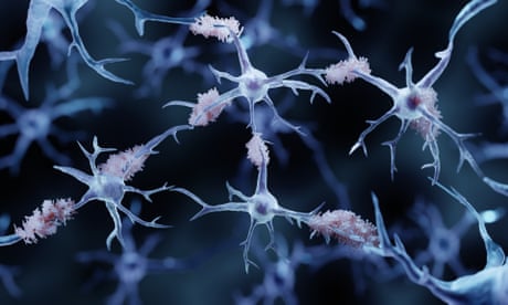 FDA approves breakthrough Alzheimer’s drug Lecanemab